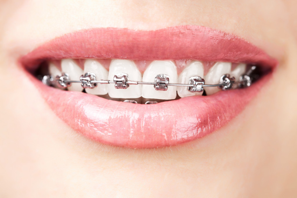 Woman with braces